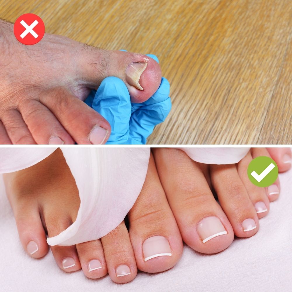 NailMaster™ - Schneidet selbst die härtesten Nägel und Nagelecken mit Leichtigkeit!